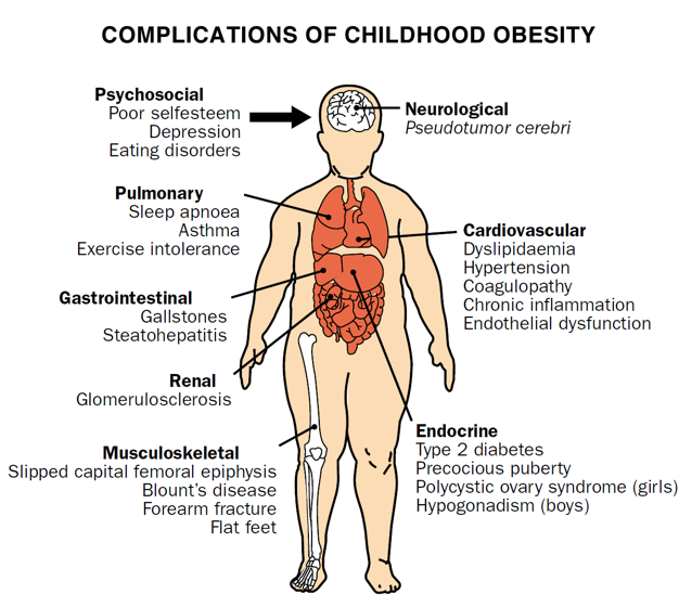 bariatric surgery child obesity