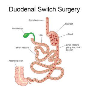 Duodenal switch bariatrics